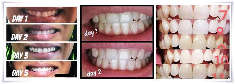 MySmile-Teeth-Whitening-Kit-Review-Closetsamples-3.jpg